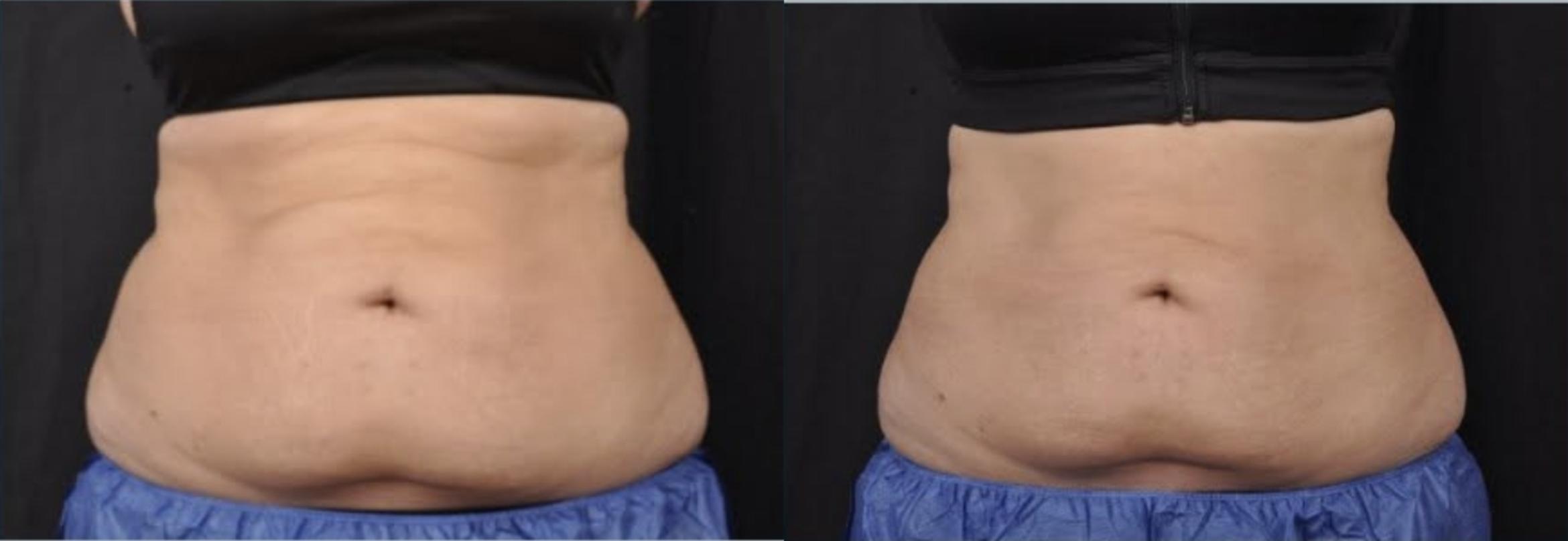 Before & After CoolSculpting® Elite Case 60668 Front View in Virginia Beach, VA