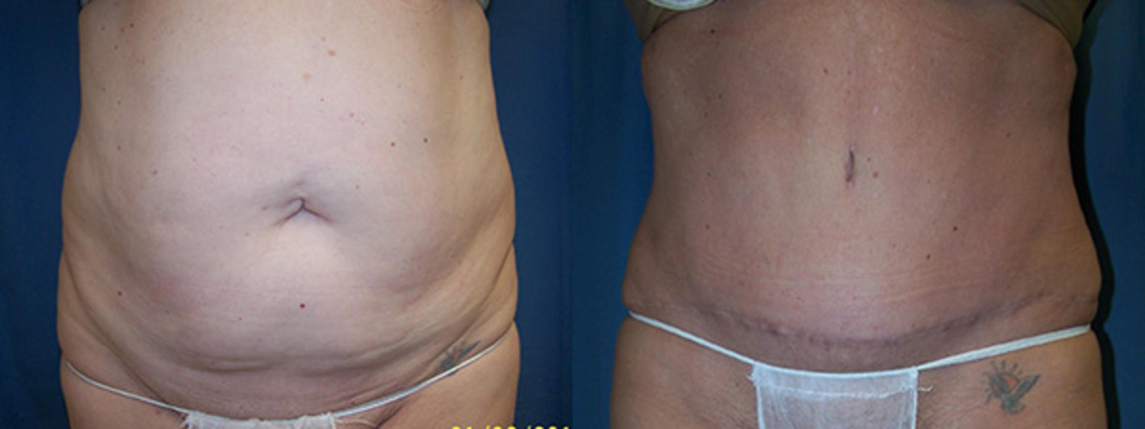 Before & After Abdominoplasty Case 2728 View 1 View in Virginia Beach, VA