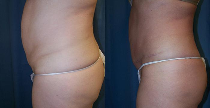 Before & After Abdominoplasty Case 2728 View 2 View in Virginia Beach, VA