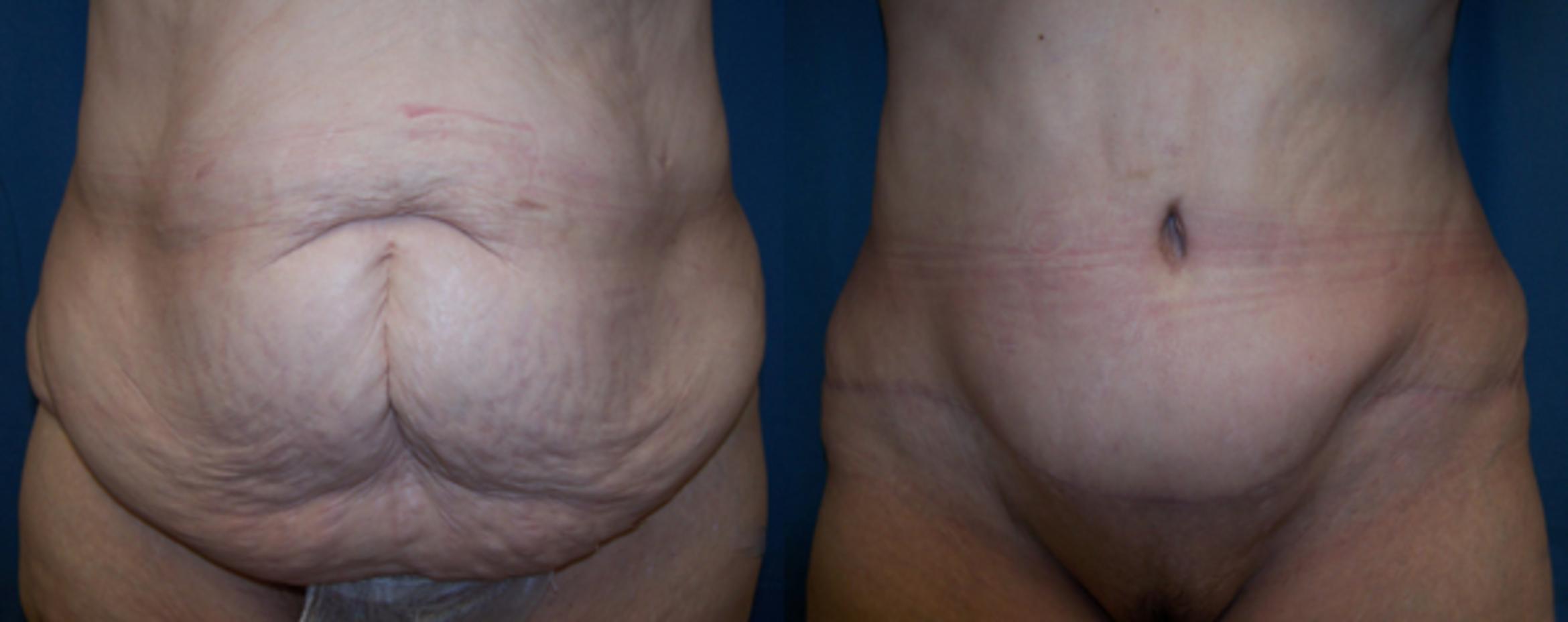 Before & After Abdominoplasty Case 2826 View 1 View in Virginia Beach, VA