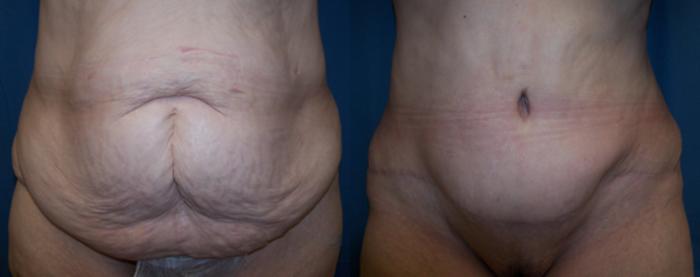 Before & After Abdominoplasty Case 2826 View 1 View in Virginia Beach, VA