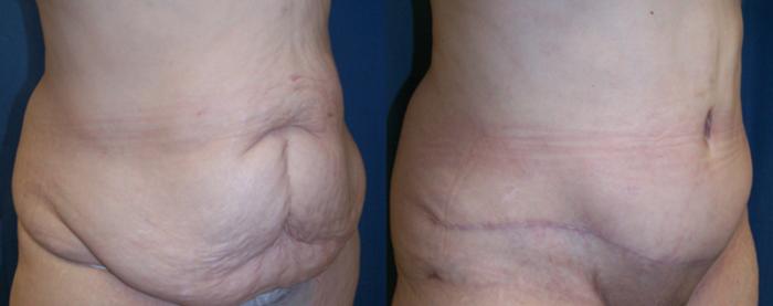 Before & After Abdominoplasty Case 2826 View 2 View in Virginia Beach, VA