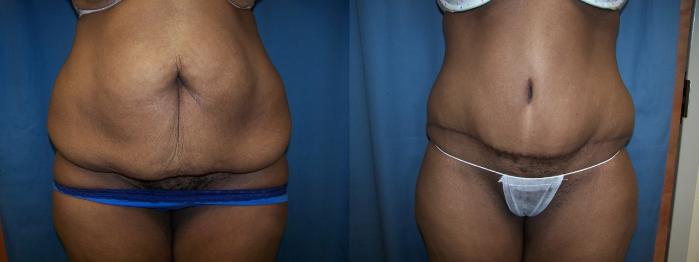 Before & After Abdominoplasty Case 3325 View 1 View in Virginia Beach, VA