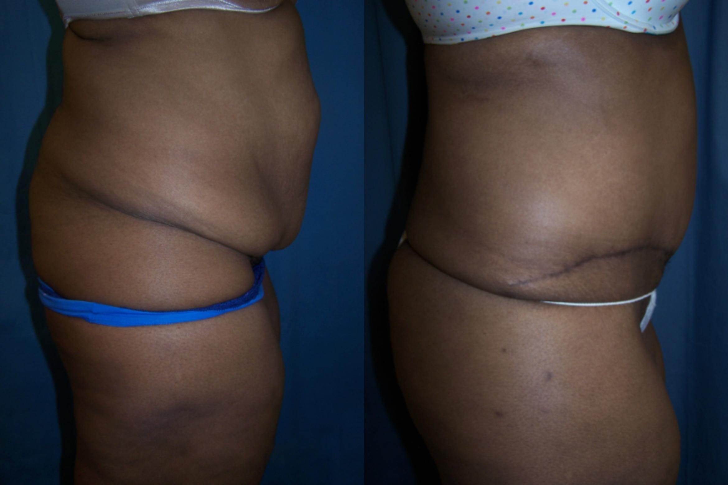 Before & After Abdominoplasty Case 3325 View 2 View in Virginia Beach, VA