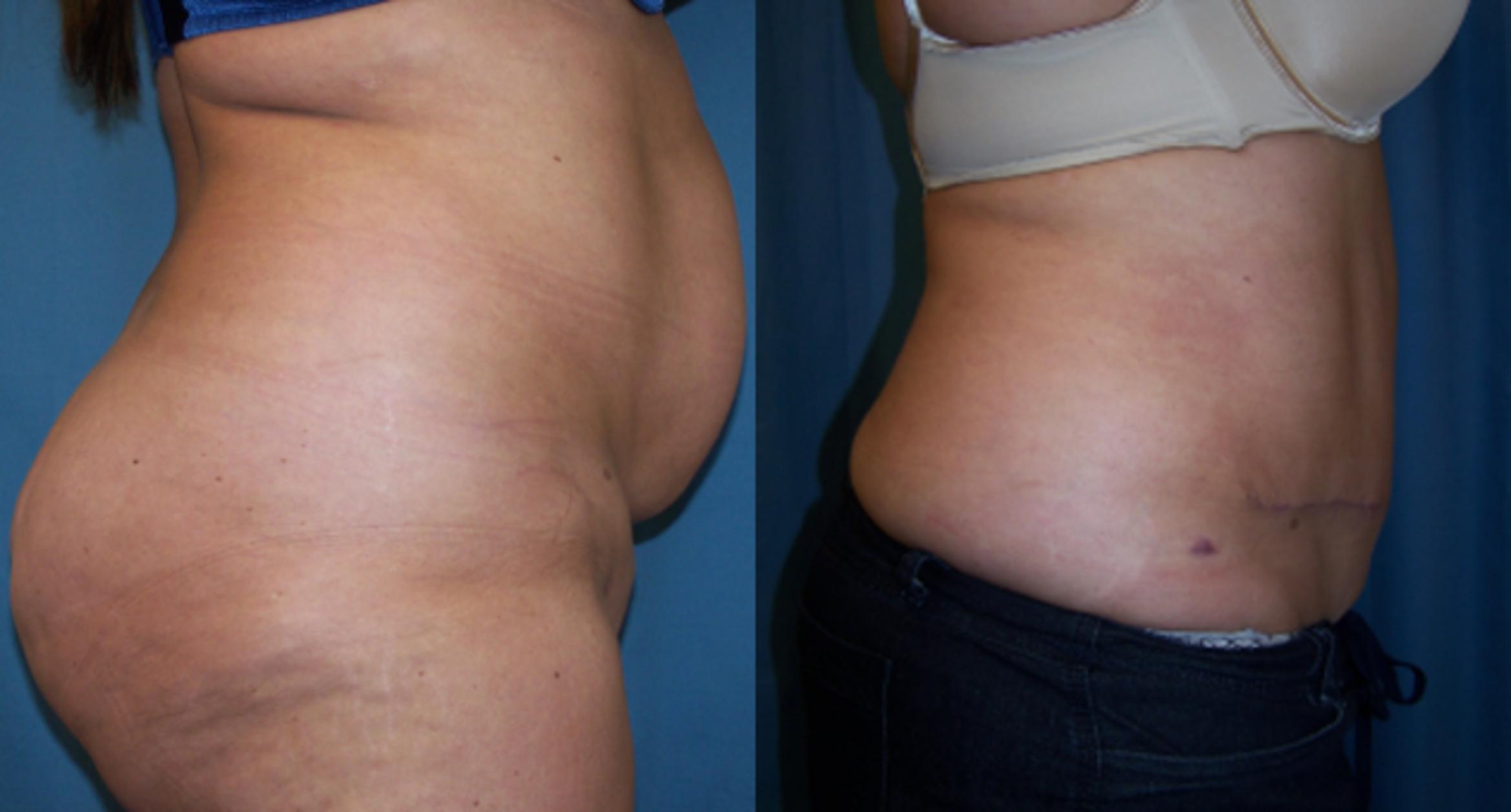 Before & After Abdominoplasty Case 3400 View 1 View in Virginia Beach, VA