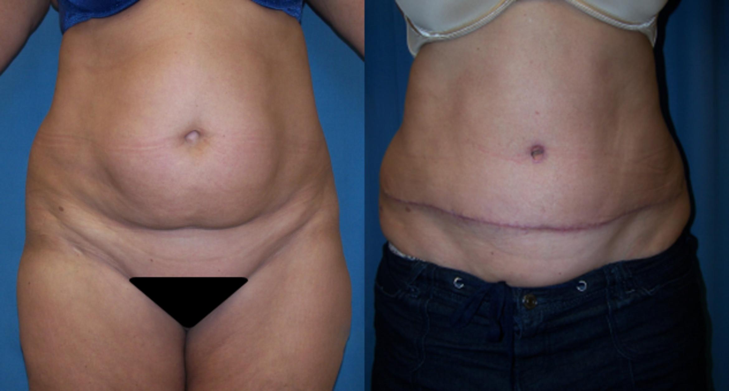 Before & After Abdominoplasty Case 3400 View 2 View in Virginia Beach, VA