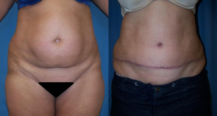 Before & After Abdominoplasty Case 3400 View 2 View in Virginia Beach, VA