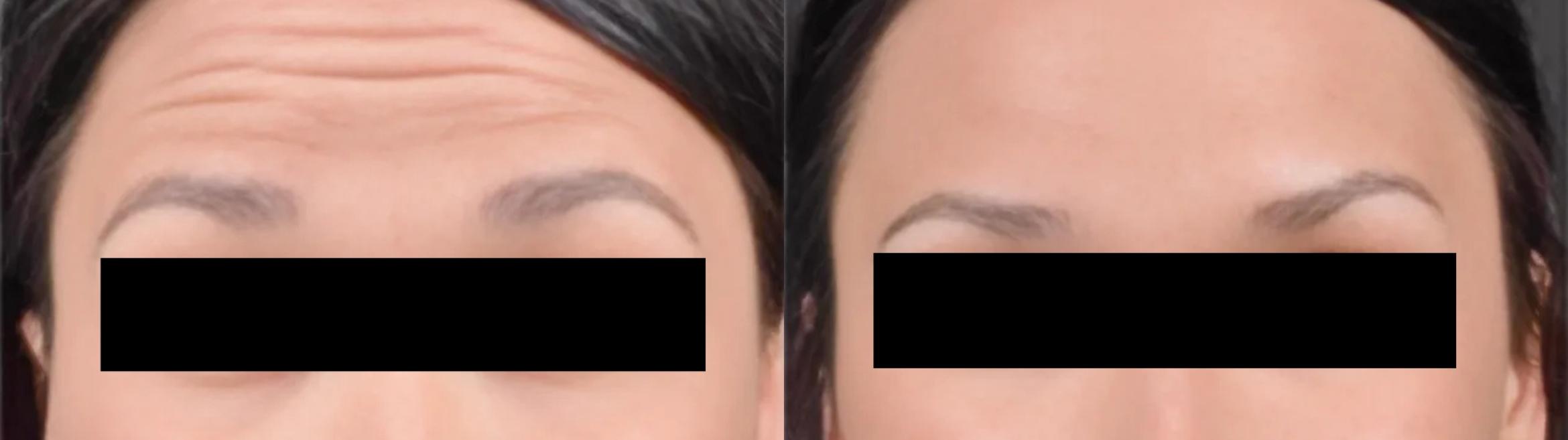 Before & After BOTOX® Case 15 Forehead View in Virginia Beach, VA