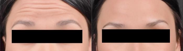Before & After BOTOX® Case 15 Forehead View in Virginia Beach, VA