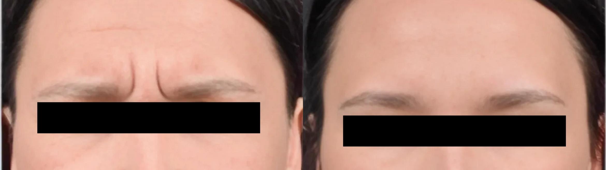 Before & After BOTOX® Case 15 Frown Lines View in Virginia Beach, VA