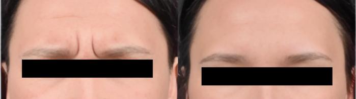 Before & After BOTOX® Case 15 Frown Lines View in Virginia Beach, VA