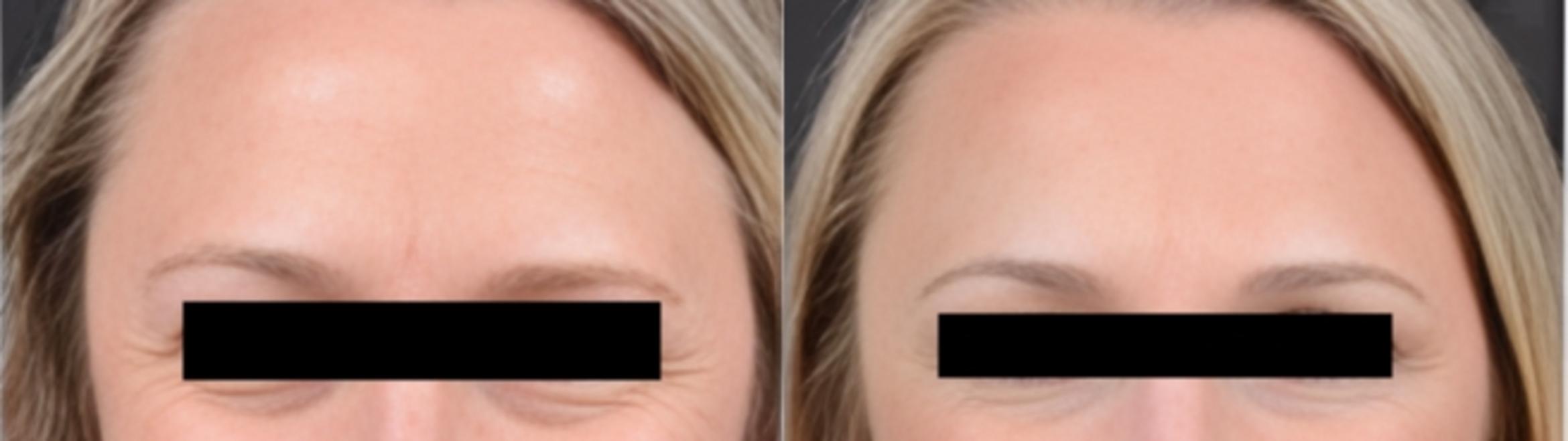 Before & After BOTOX® Case 16 Crows Feet View in Virginia Beach, VA