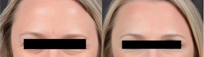 Before & After BOTOX® Case 16 Crows Feet View in Virginia Beach, VA
