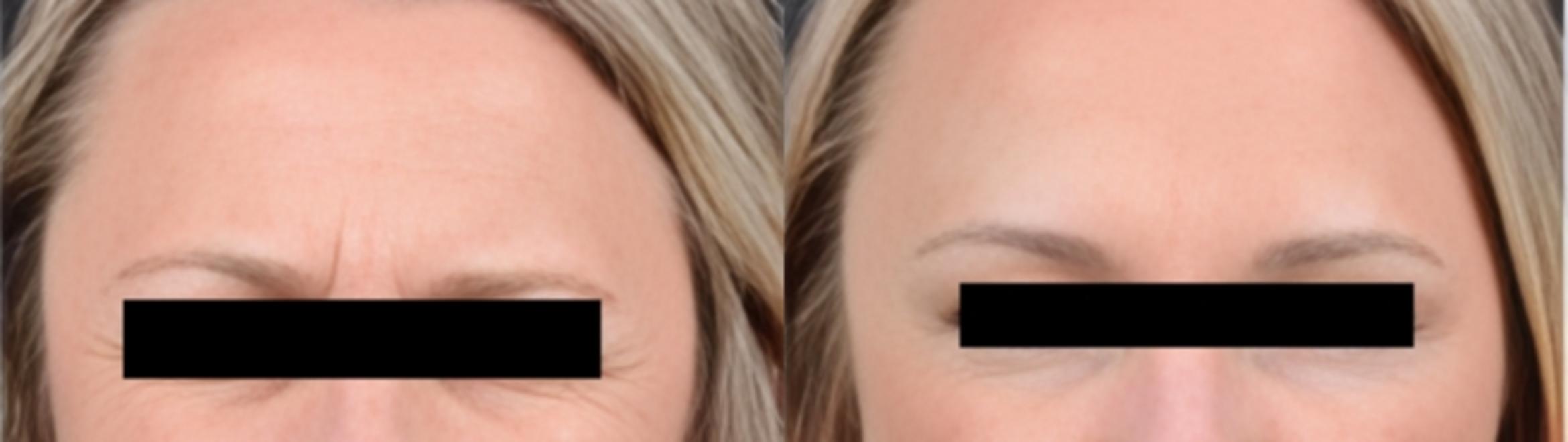 Before & After BOTOX® Case 16 Frown Lines View in Virginia Beach, VA