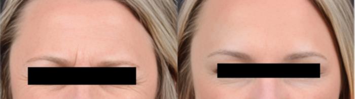 Before & After BOTOX® Case 16 Frown Lines View in Virginia Beach, VA