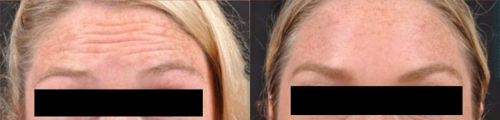 Before & After BOTOX® Case 28272 View 1 View in Virginia Beach, VA