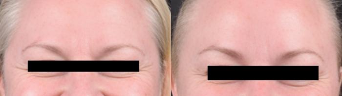 Before & After BOTOX® Case 60624 Crows Feet View in Virginia Beach, VA