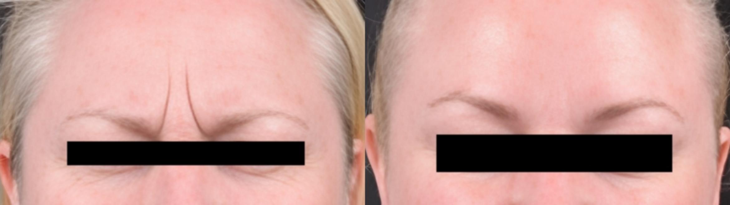 Before & After BOTOX® Case 60624 Frown Lines View in Virginia Beach, VA