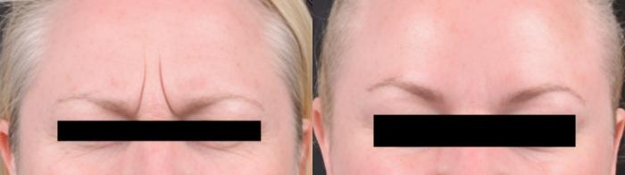Before & After BOTOX® Case 60624 Frown Lines View in Virginia Beach, VA