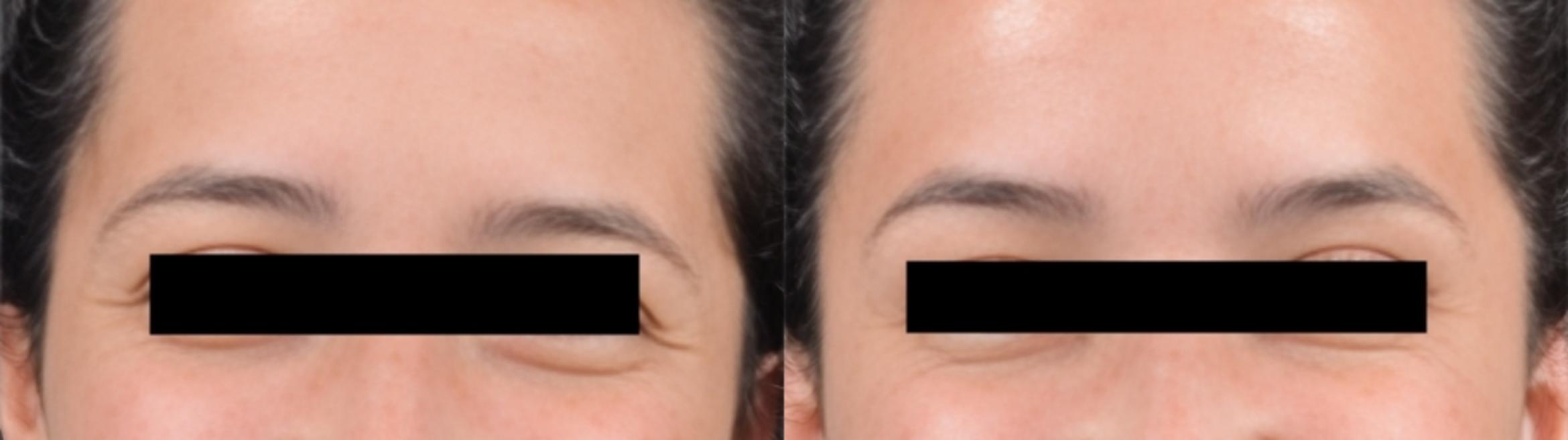 Before & After BOTOX® Case 60626 Crows Feet View in Virginia Beach, VA