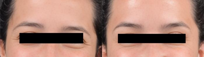 Before & After BOTOX® Case 60626 Crows Feet View in Virginia Beach, VA