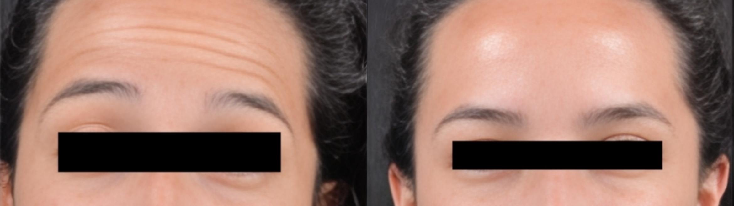 Before & After BOTOX® Case 60626 Forehead View in Virginia Beach, VA