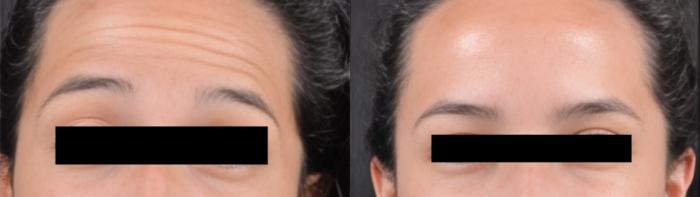 Before & After BOTOX® Case 60626 Forehead View in Virginia Beach, VA
