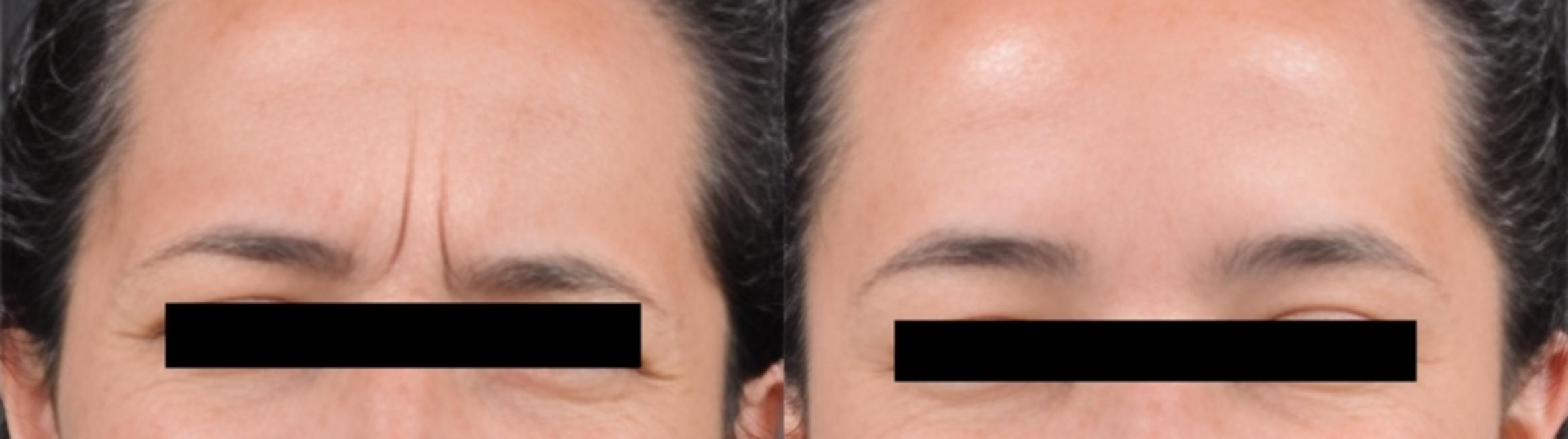 Before & After BOTOX® Case 60626 Frown Lines View in Virginia Beach, VA