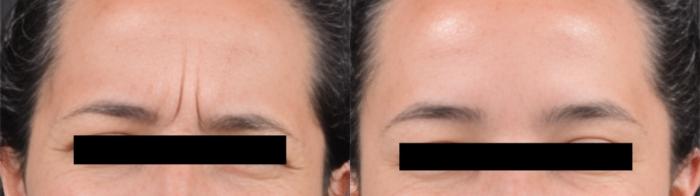 Before & After BOTOX® Case 60626 Frown Lines View in Virginia Beach, VA
