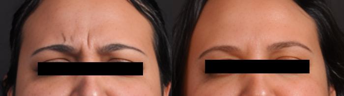 Before & After BOTOX® Case 60660 Front View in Virginia Beach, VA