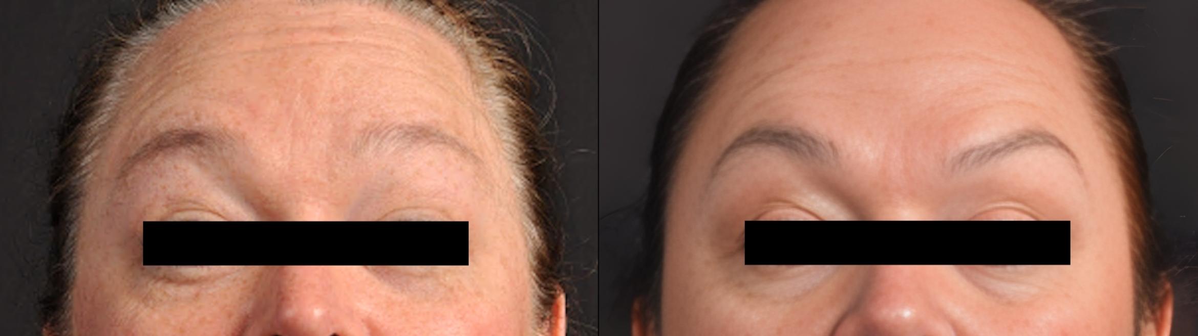 Before & After BOTOX® Case 60661 Front View in Virginia Beach, VA