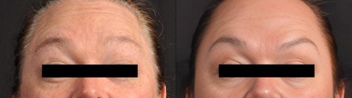 Before & After BOTOX® Case 60661 Front View in Virginia Beach, VA