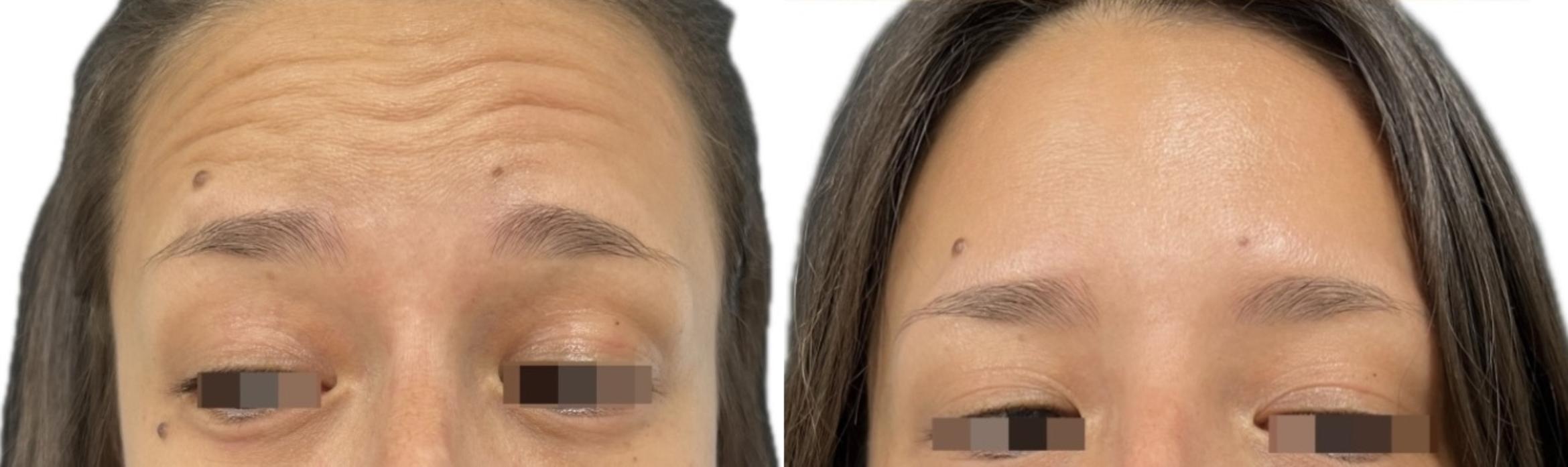 Before & After BOTOX® Case 60663 Front View in Virginia Beach, VA