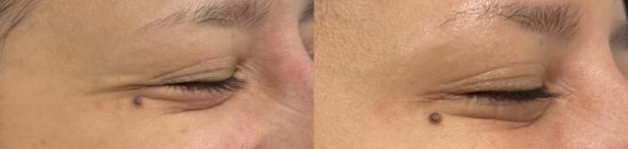 Before & After BOTOX® Case 60665 Left Side View in Virginia Beach, VA