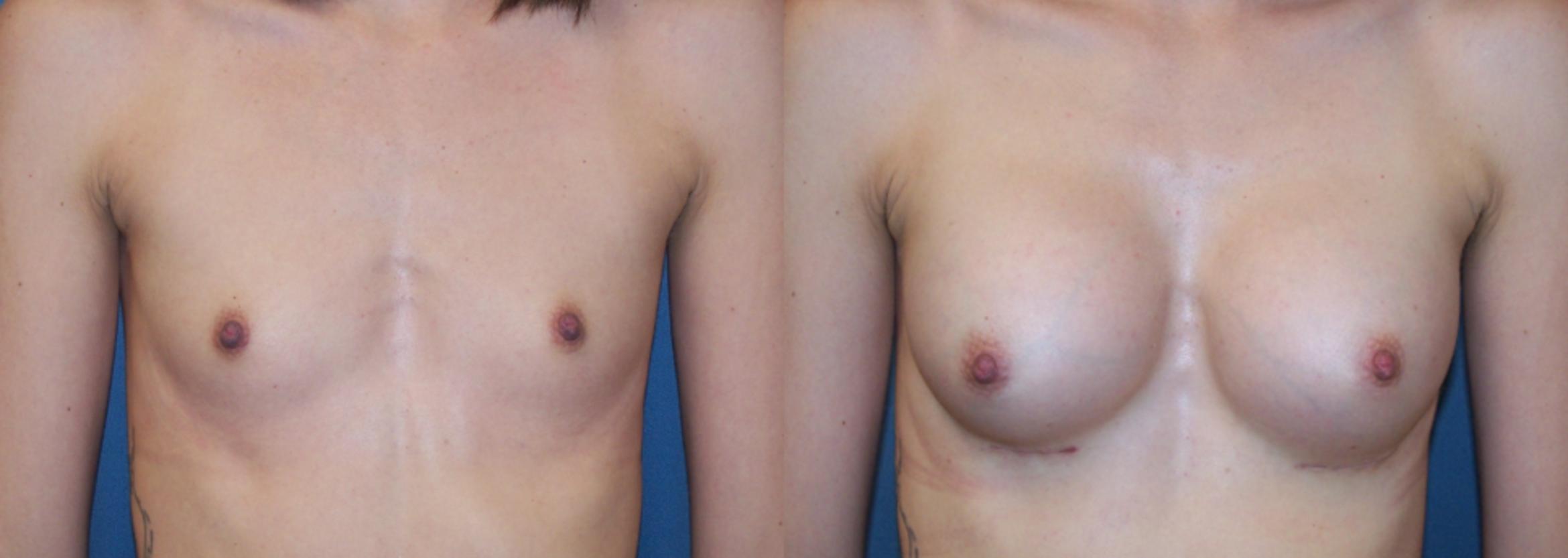 Before & After Breast Augmentation Case 3384 View 1 View in Virginia Beach, VA