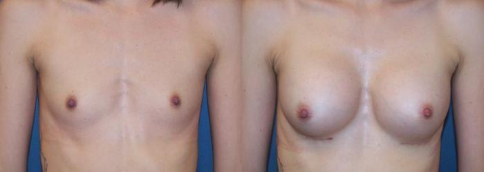 Before & After Breast Augmentation Case 3384 View 1 View in Virginia Beach, VA