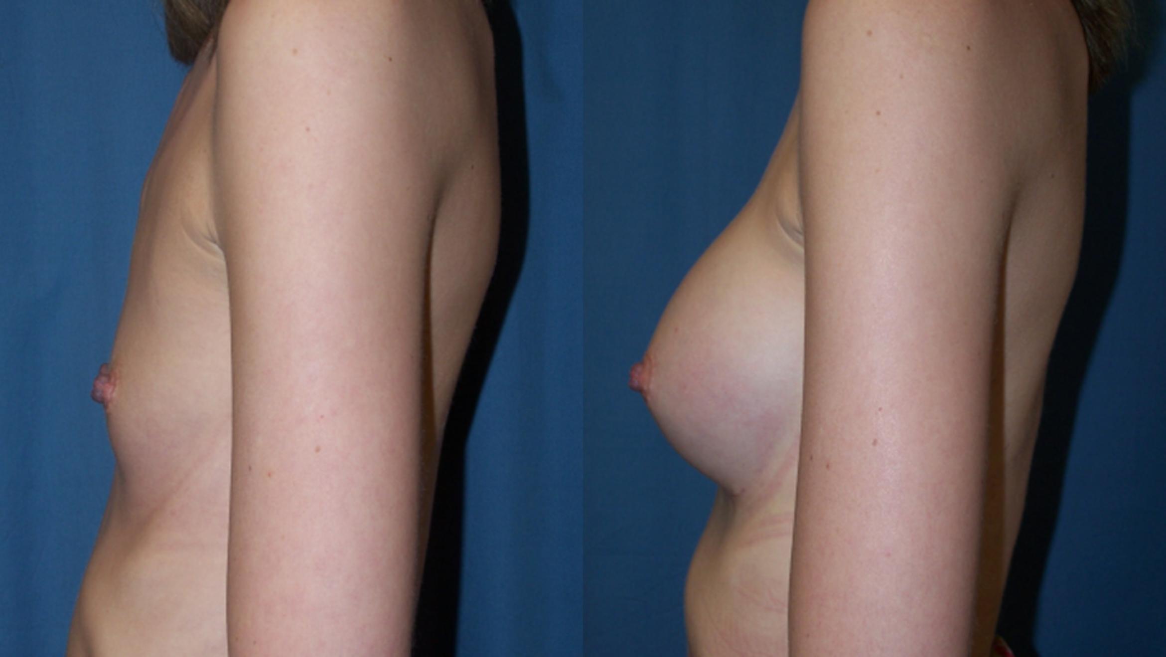 Before & After Breast Augmentation Case 3384 View 2 View in Virginia Beach, VA