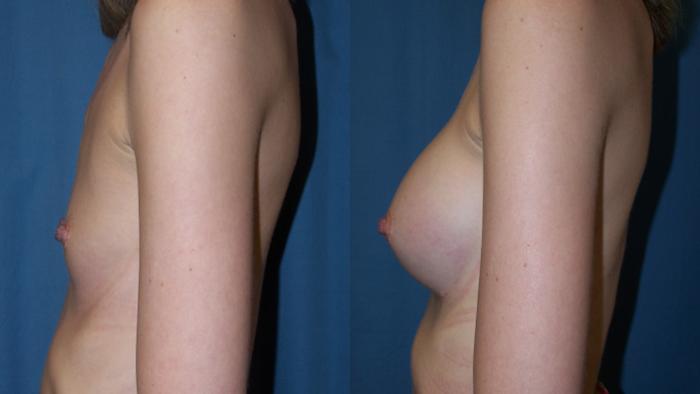 Before & After Breast Augmentation Case 3384 View 2 View in Virginia Beach, VA