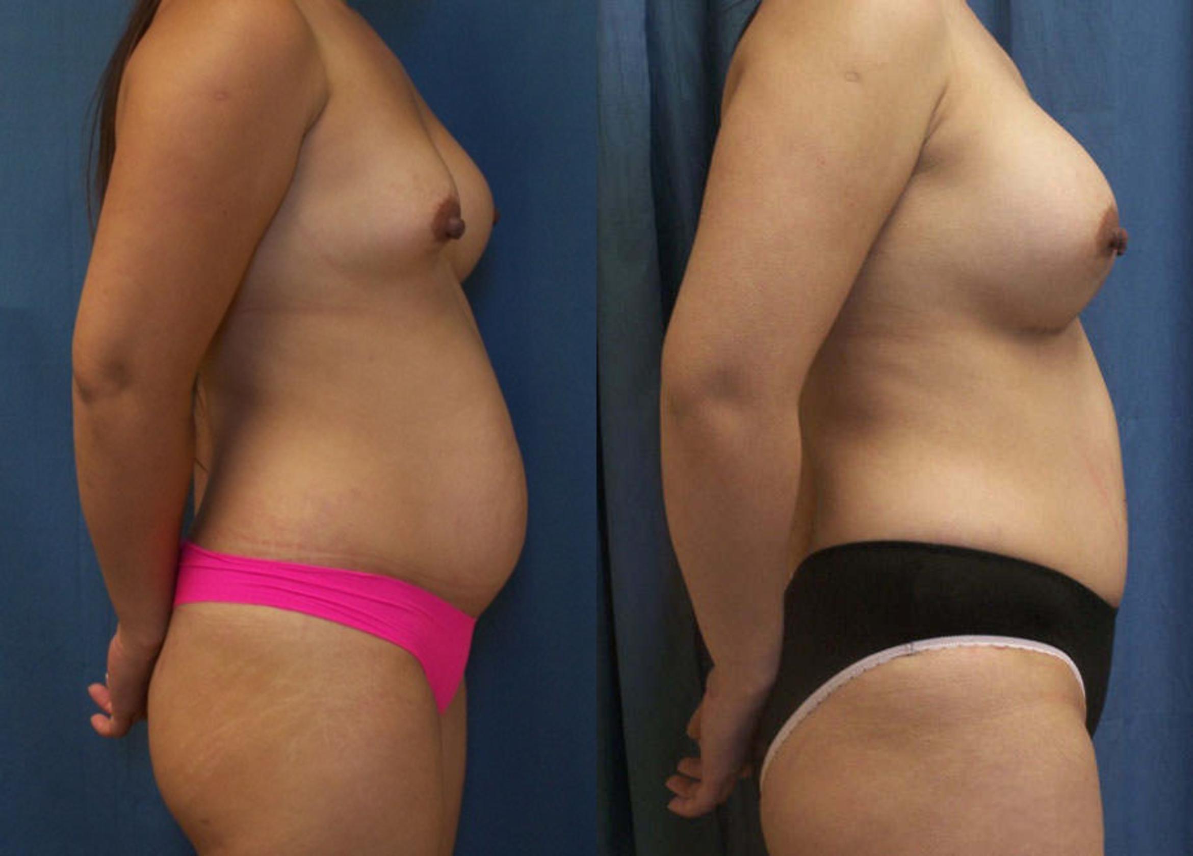 Before & After Breast Augmentation Case 3749 View 1 View in Virginia Beach, VA