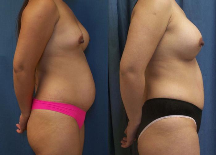 Before & After Breast Augmentation Case 3749 View 1 View in Virginia Beach, VA