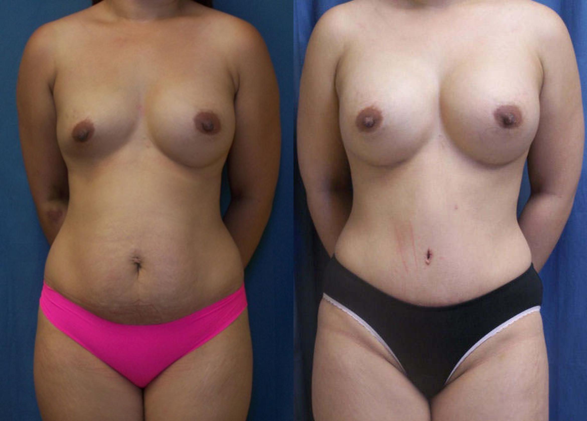 Before & After Breast Augmentation Case 3749 View 2 View in Virginia Beach, VA