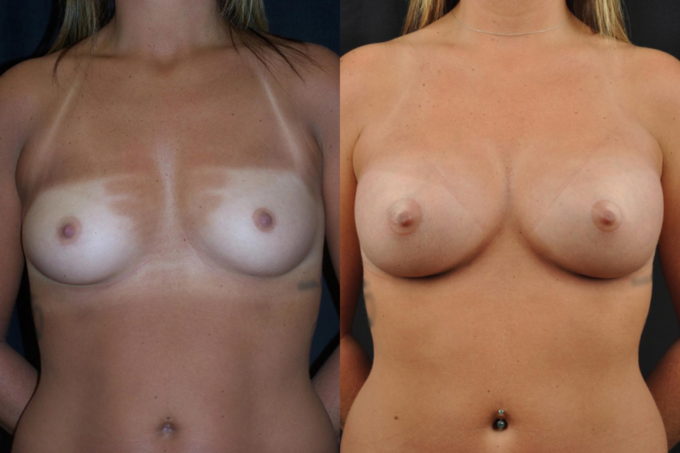 Before & After Breast Augmentation Case 4126 View 1 View in Virginia Beach, VA