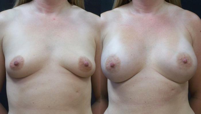 Before & After Breast Augmentation Case 4141 View 1 View in Virginia Beach, VA