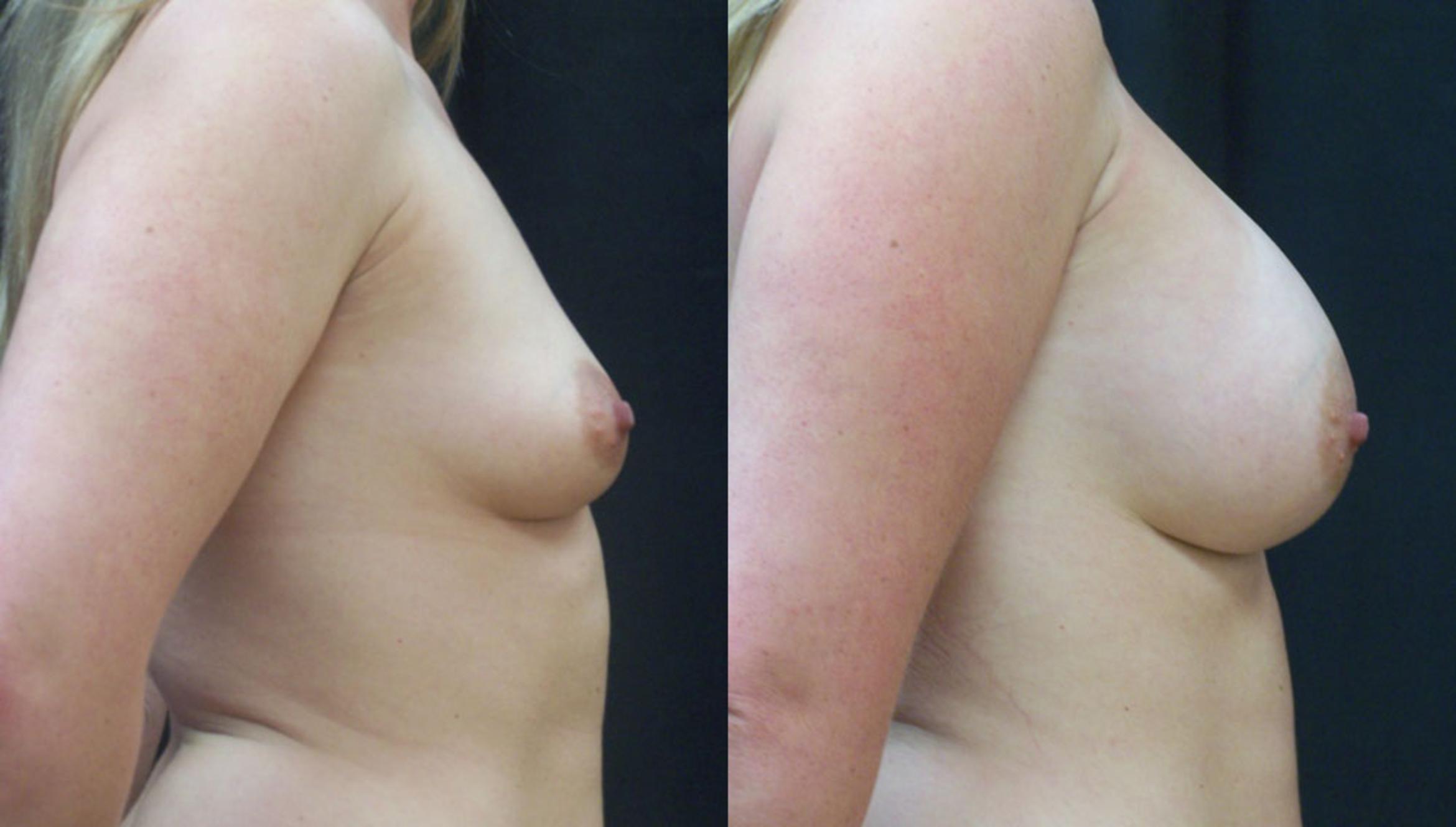 Before & After Breast Augmentation Case 4141 View 2 View in Virginia Beach, VA