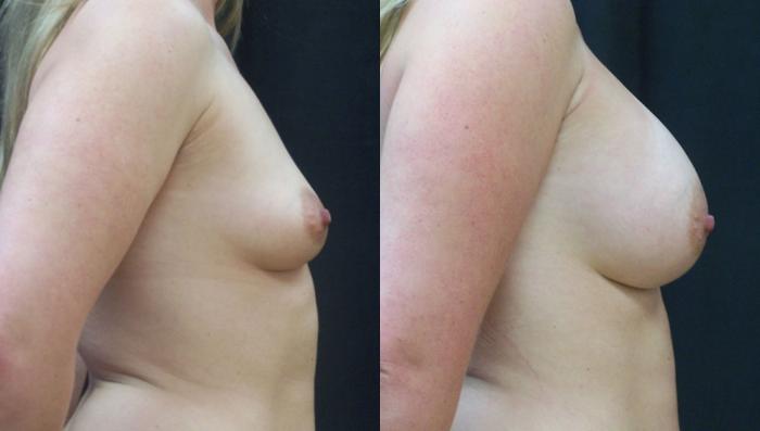 Before & After Breast Augmentation Case 4141 View 2 View in Virginia Beach, VA