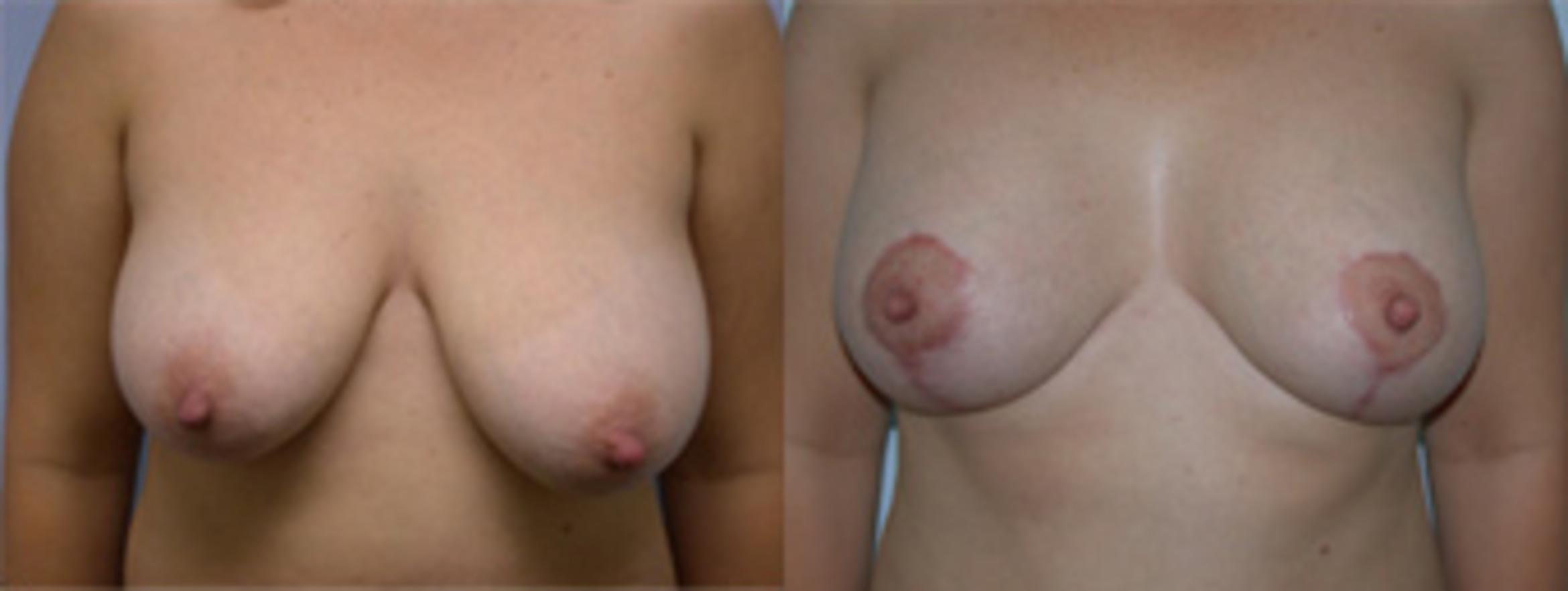 Before & After Breast Lift Case 2630 View 1 View in Virginia Beach, VA