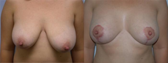 Before & After Breast Lift Case 2630 View 1 View in Virginia Beach, VA