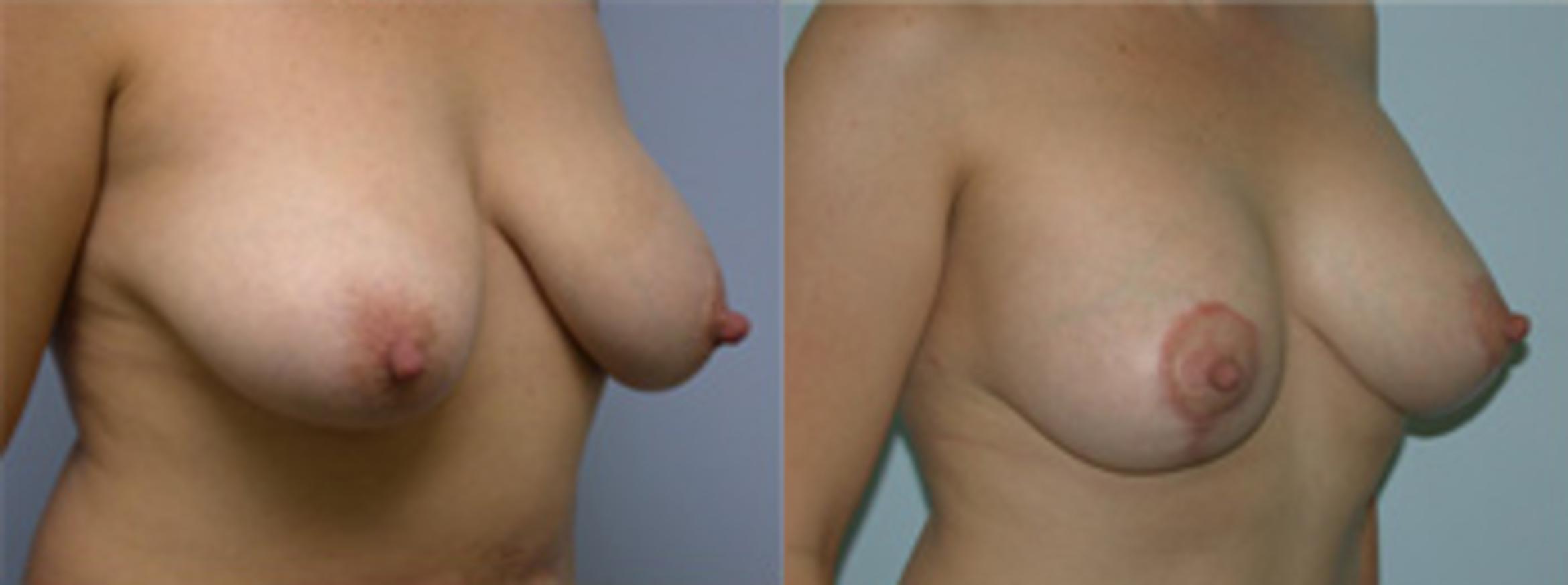 Before & After Breast Lift Case 2630 View 2 View in Virginia Beach, VA