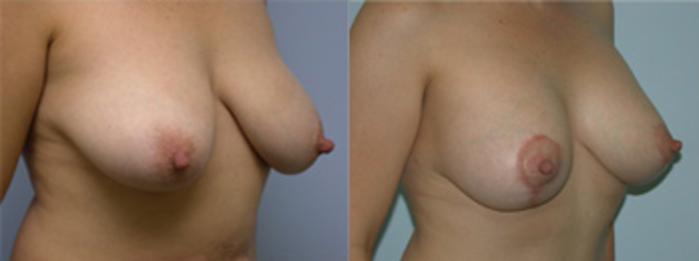 Before & After Breast Lift Case 2630 View 2 View in Virginia Beach, VA