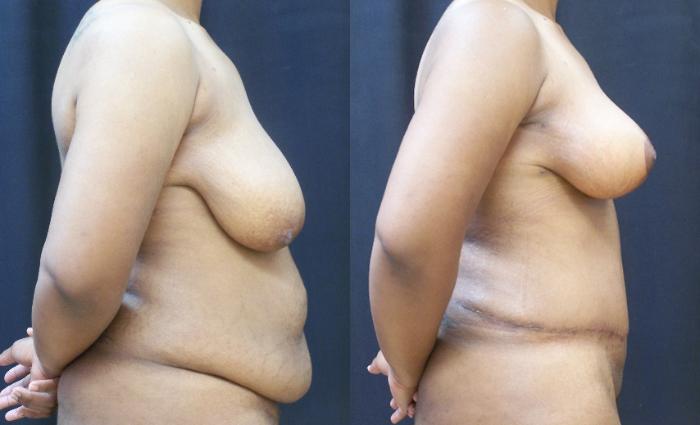 Before & After Breast Lift Case 4438 View 1 View in Virginia Beach, VA